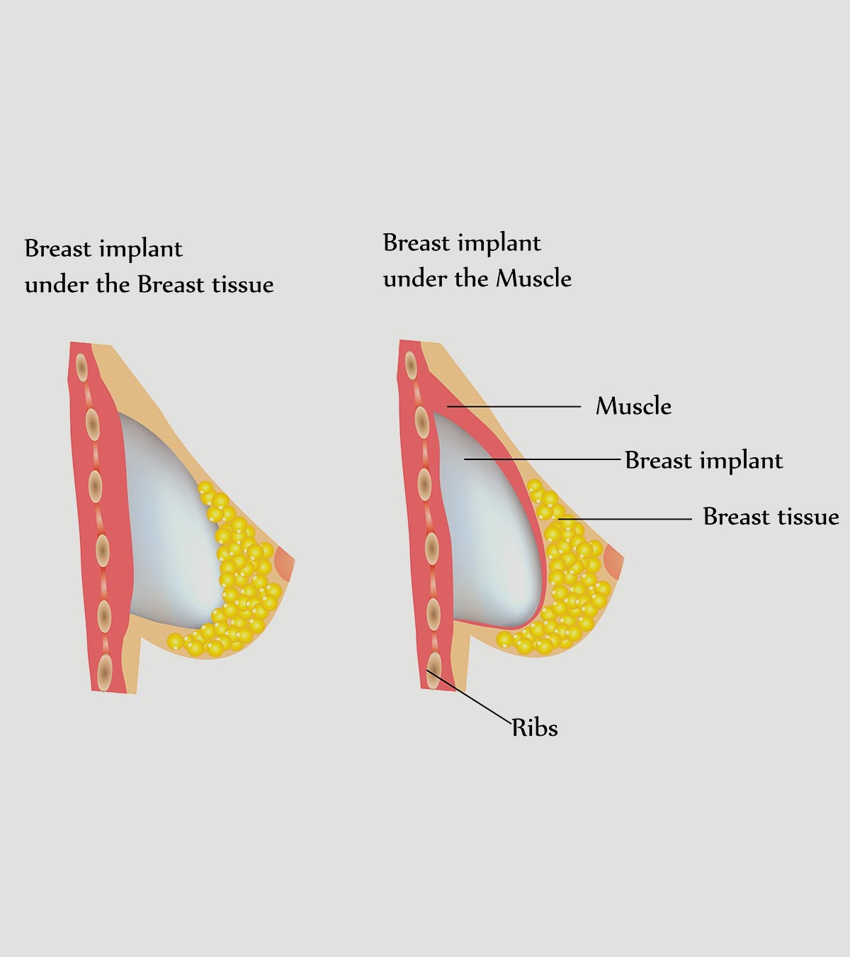 Breast Augmentation Chart