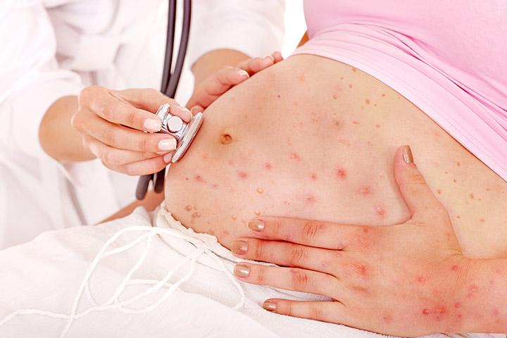 Chickenpox During Pregnancy - Causes, Symptoms, Risks & Treatments