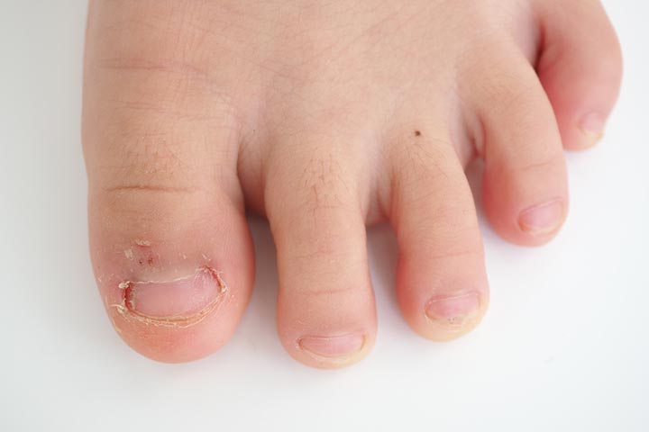 Nails falling off in a 3-year-old | MDedge Family Medicine