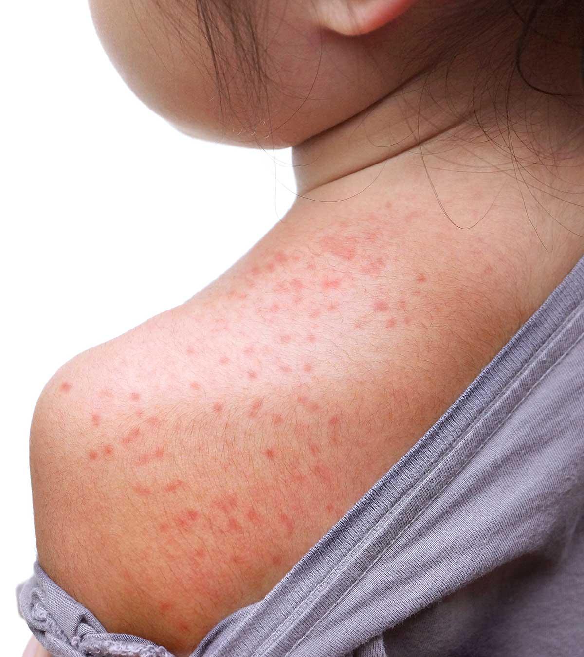 Child With Visible Heat Rashes On Their Skin