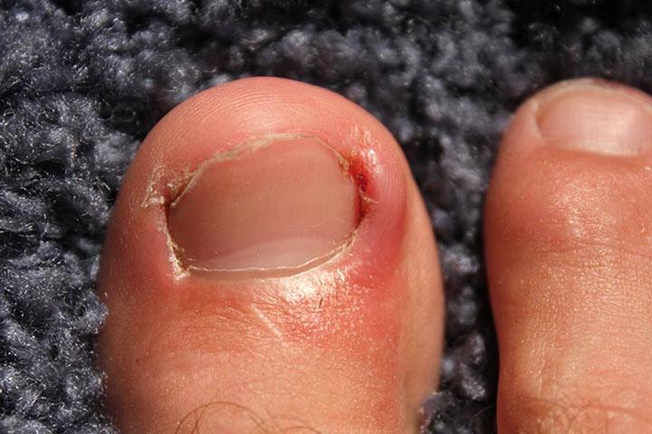 2. Ingrown Toenail - wide 4