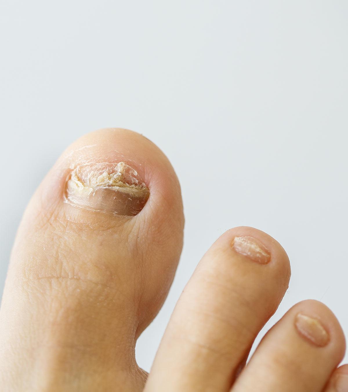 Ingrown toenails in kid