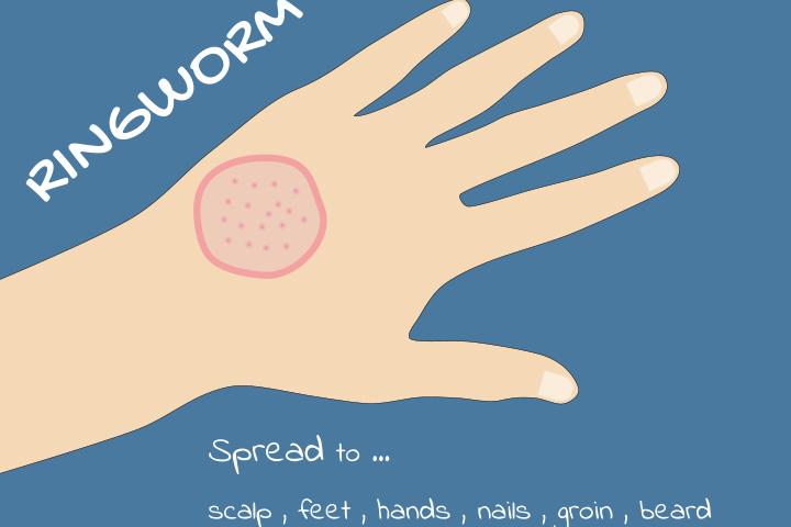 Itchy patches on the skin.