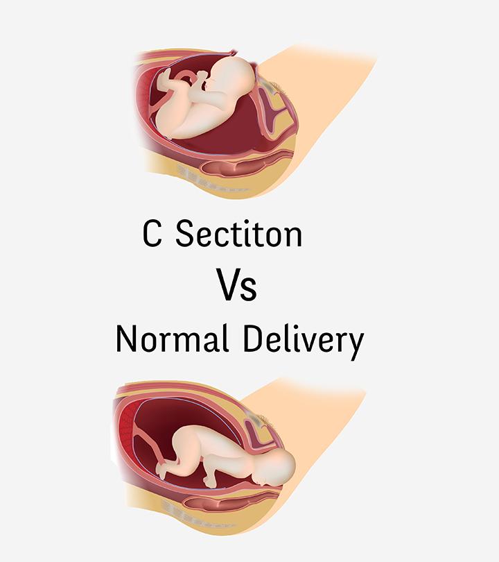 C-Section Vs. Normal Delivery: How Are They Different C-Section Vs. Normal Delivery: How Are They Different