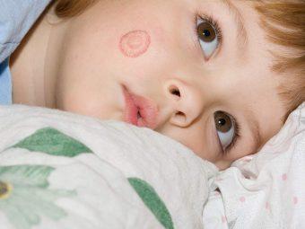 Ringworm In Kids Causes, Symptoms And Treatment