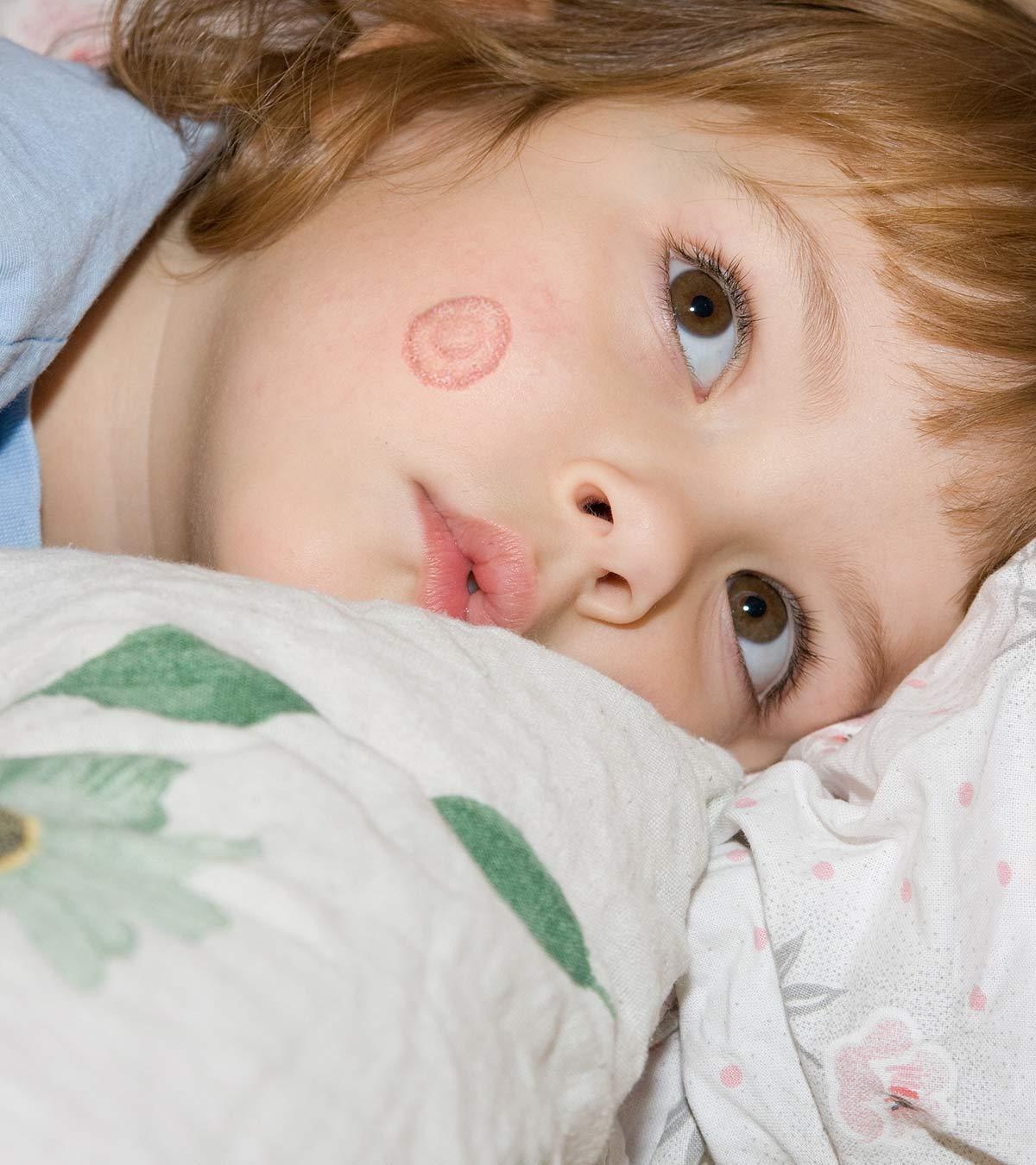 Ringworm In Kids: Types, Causes, Symptoms, Treatment & Care