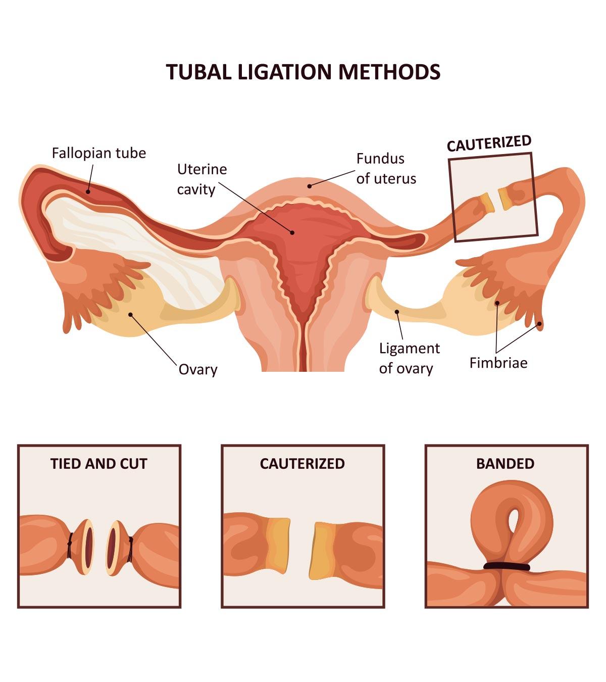 Tubal Ligation Benefits