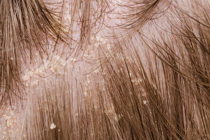 Dandruff shop in children