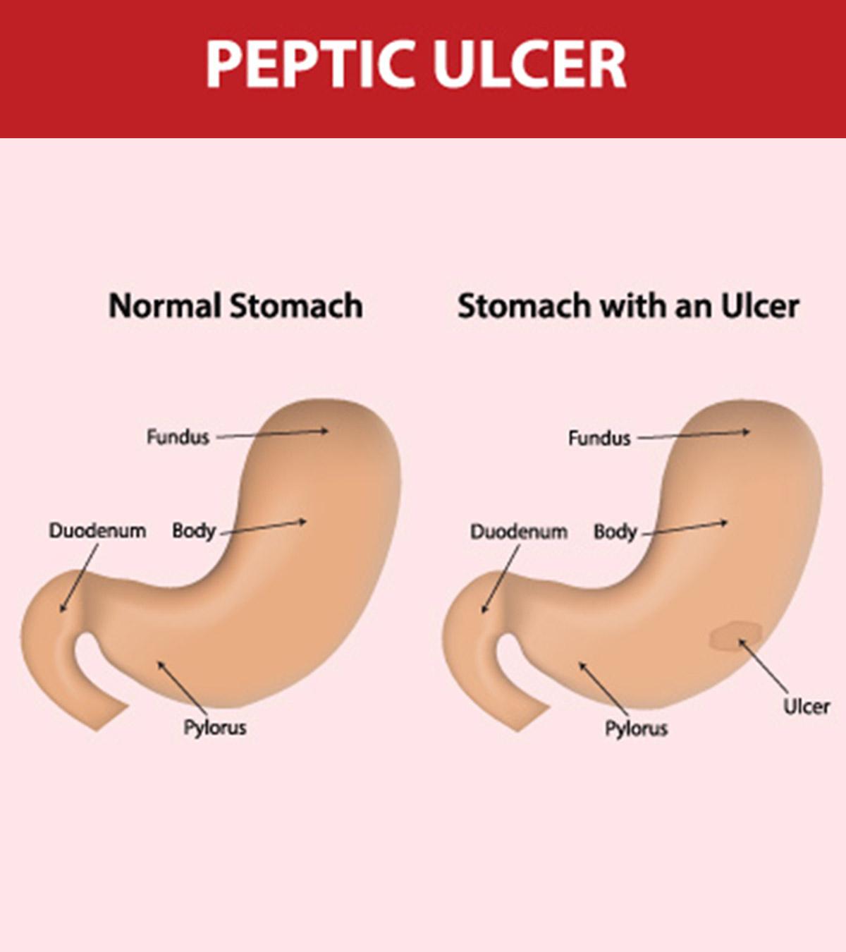 Symptoms Of Stomach Ulcer In Children