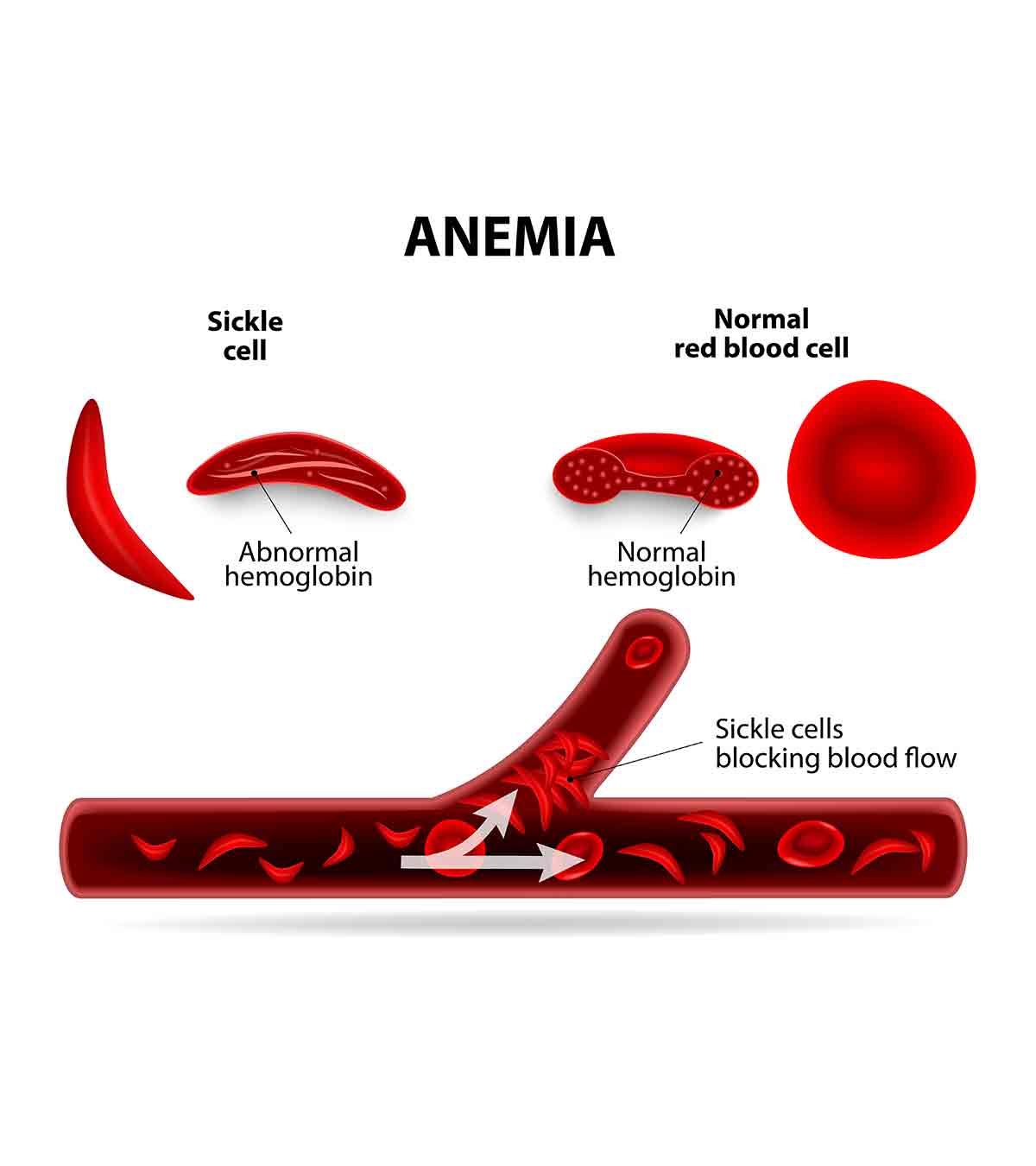 7 Signs Of Sickle Cell Disease In Babies, Types And Treatment
