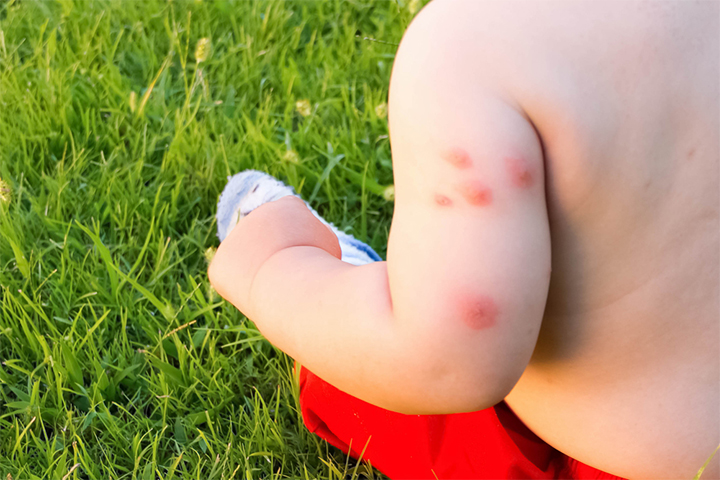 A bug bite can provide a point of entry for bacteria, causing boils