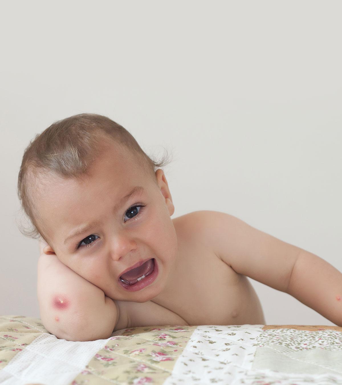 Baby Suffering From Boils
