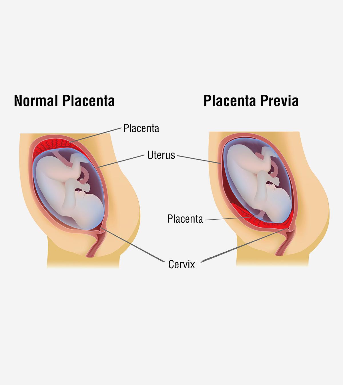 Placenta-Previa-Causes,-Symptoms-And-Treatment1