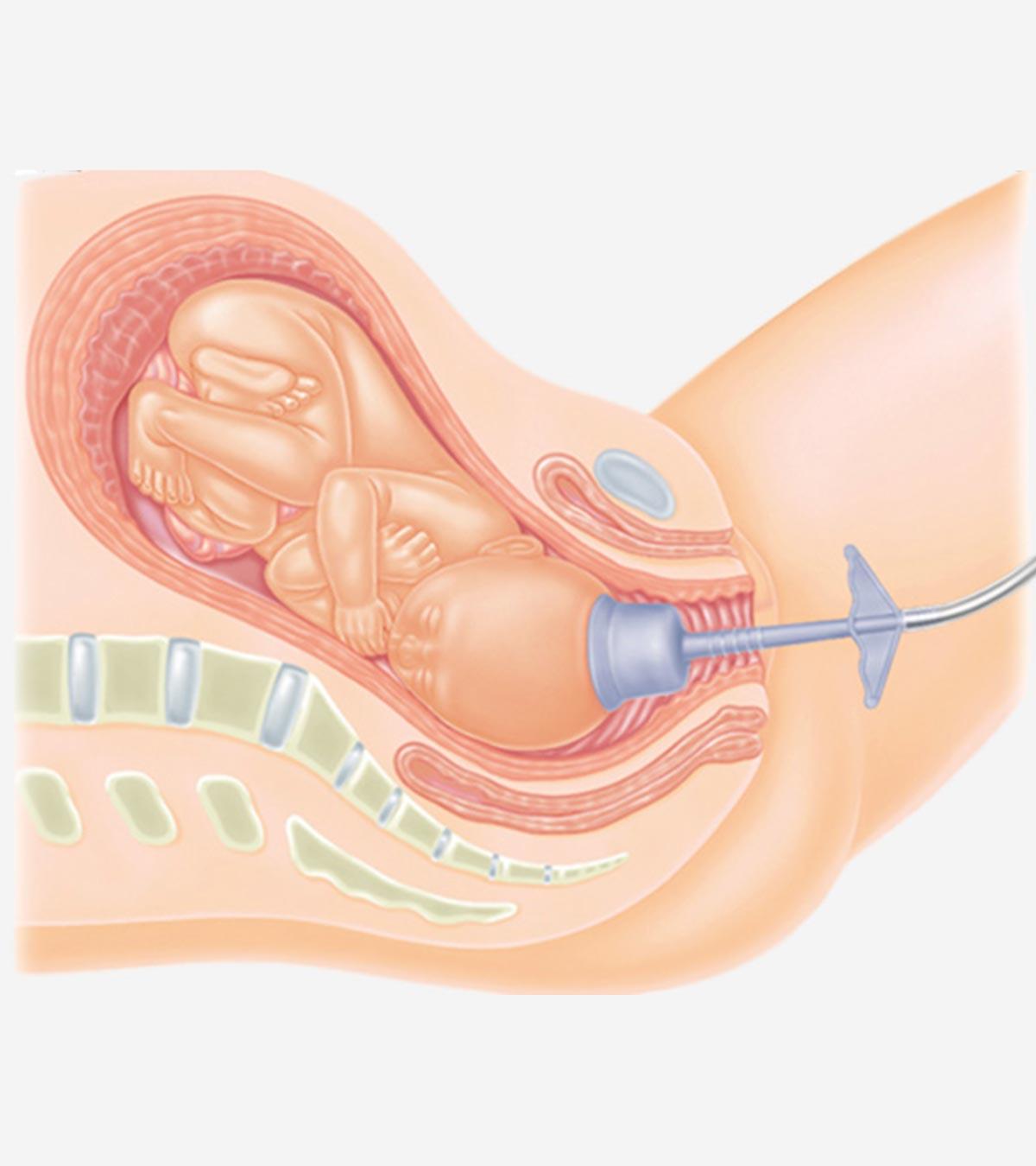 Vacuum Assisted Delivery: What It Is, Its Types & Risks