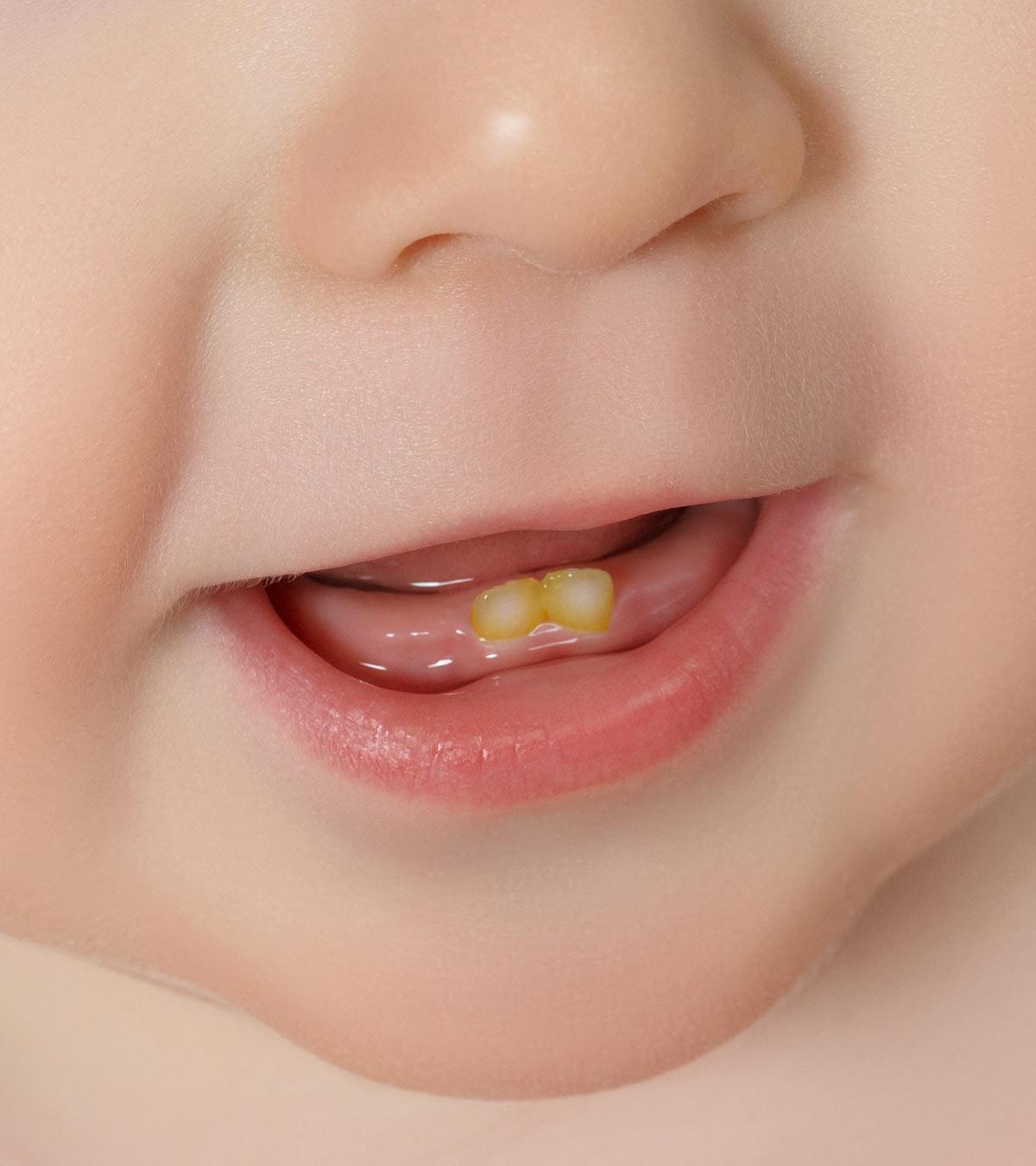 Baby Suffering From Tooth Discoloration
