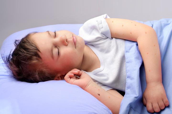 home remedies for flea bites on babies