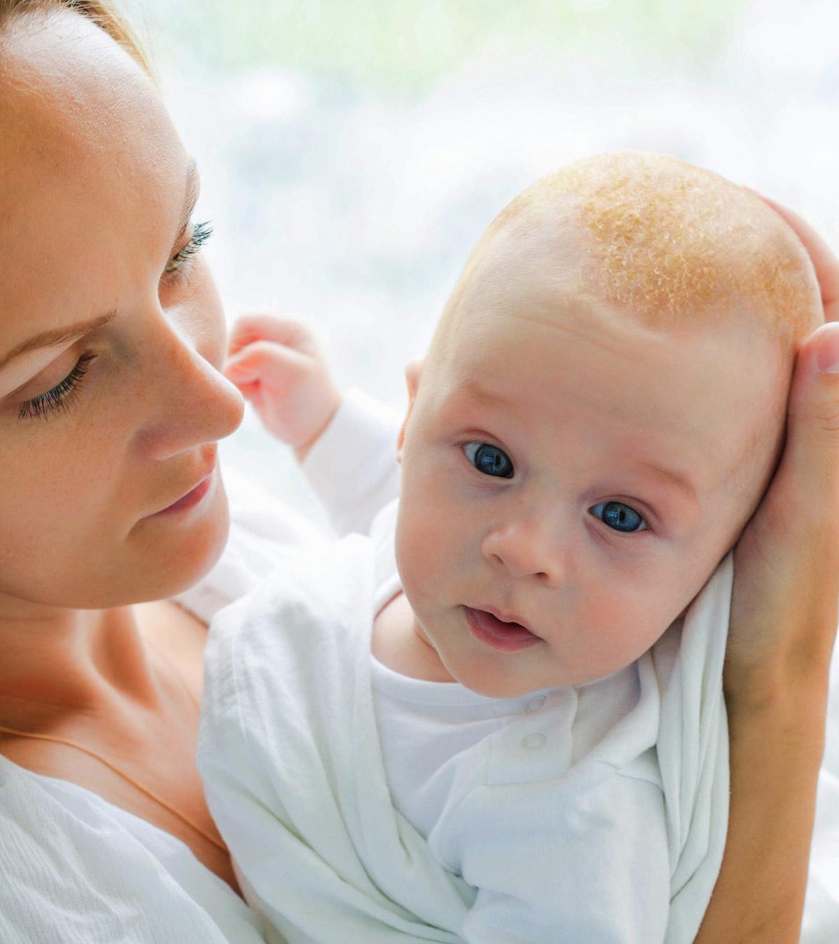 Cradle Cap Causes Symptoms And Treatment