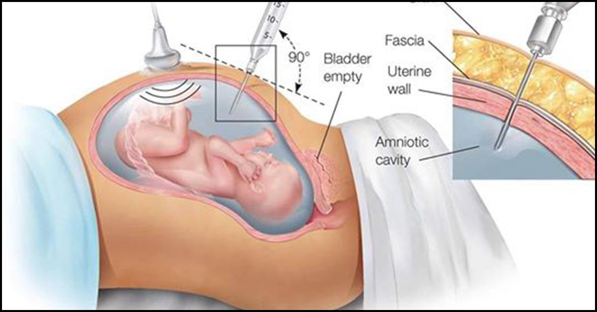 Leaking Amniotic Fluid Signs, Causes And Treatment
