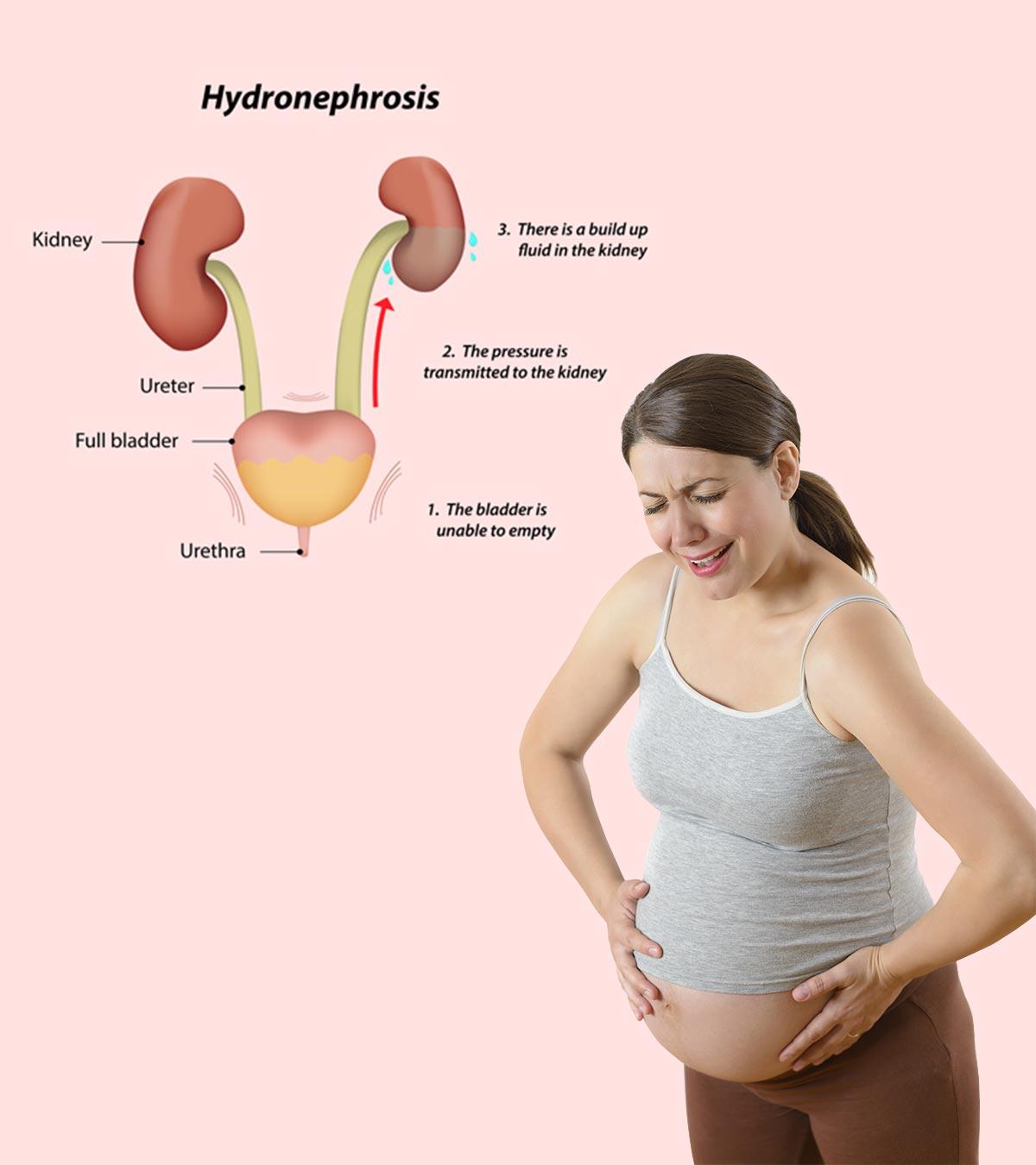 Hydronephrosis during pregnancy
