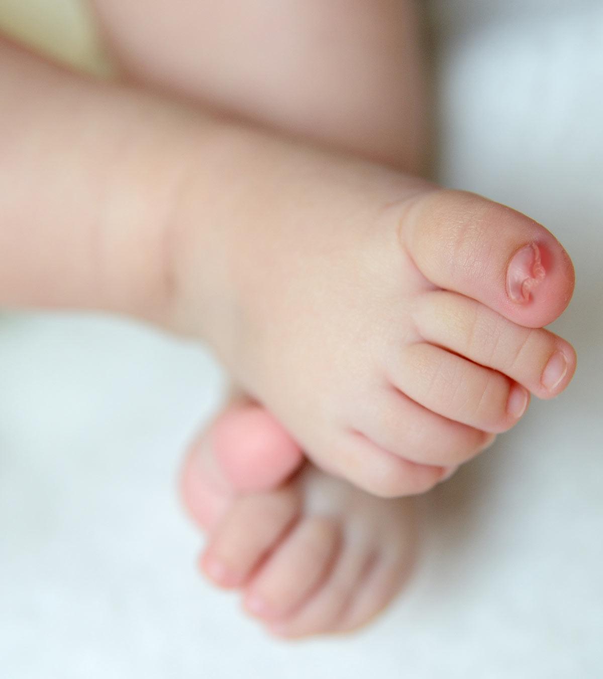 How To Treat And Prevent Ingrown Toenail In Babies?