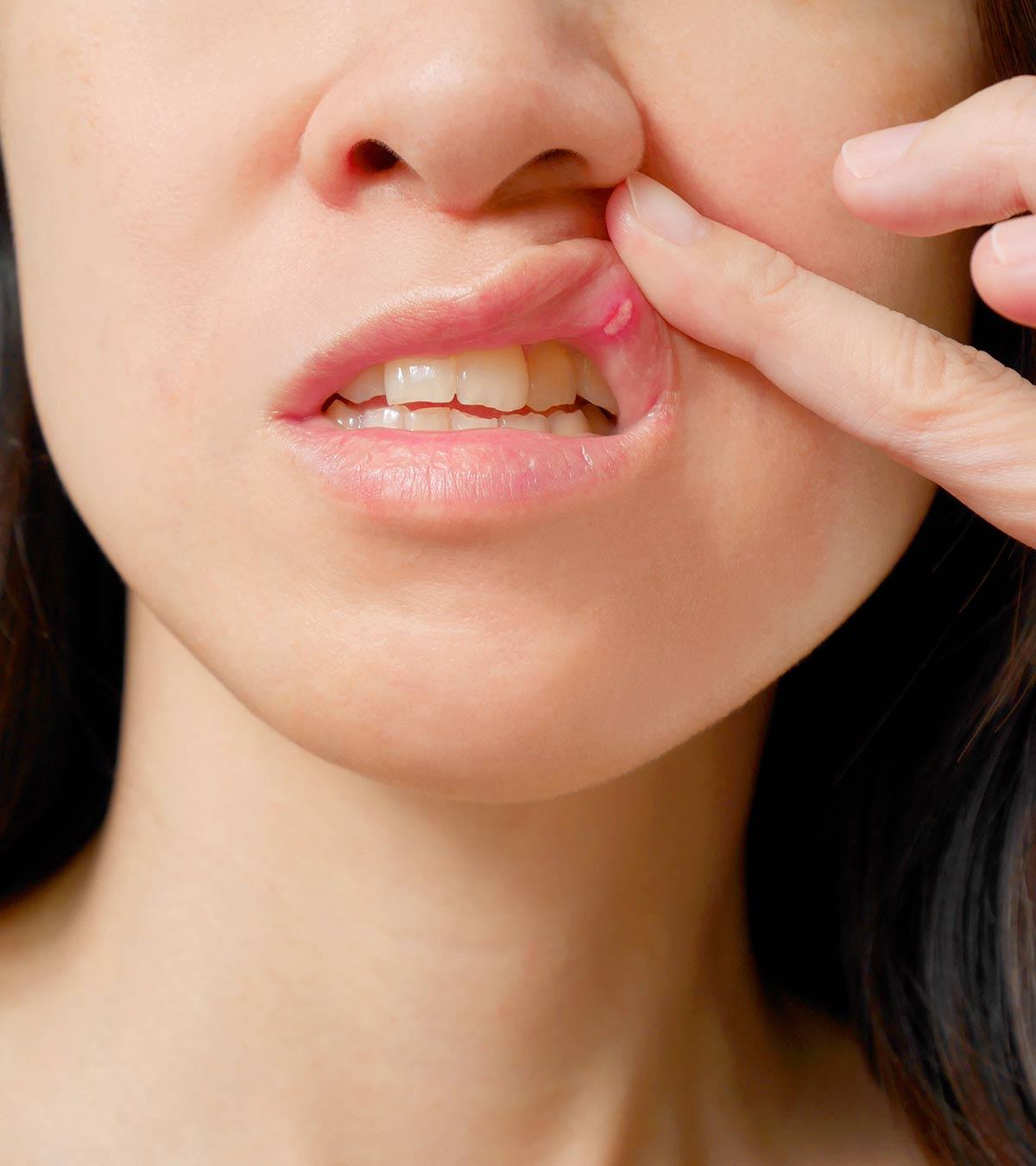 Mouth Ulcers In Pregnancy