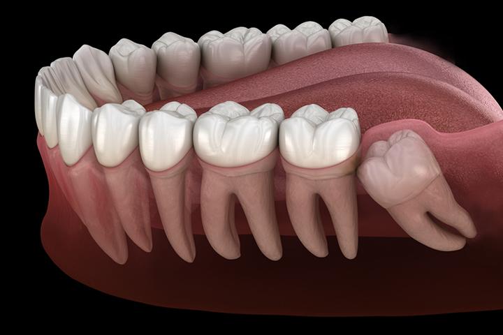 Often, wisdom teeth erupt partially or impact the jaw bone. 