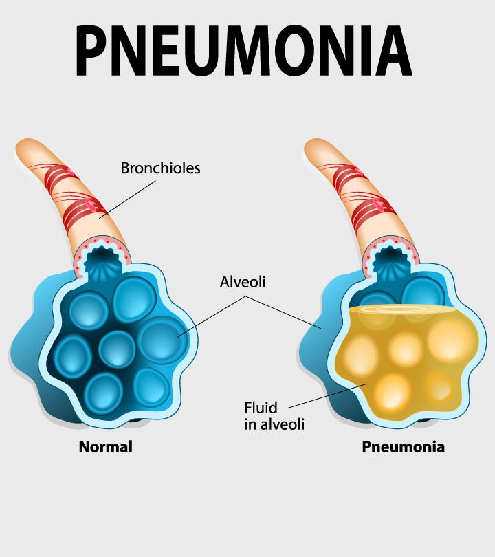Pneumonia In Pregnancy