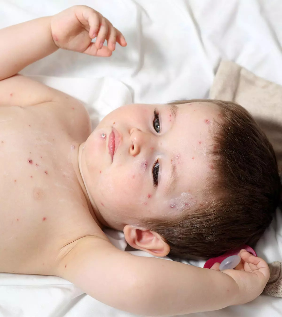 Scabies In Toddlers Causes Symptoms Treatments You Should Be