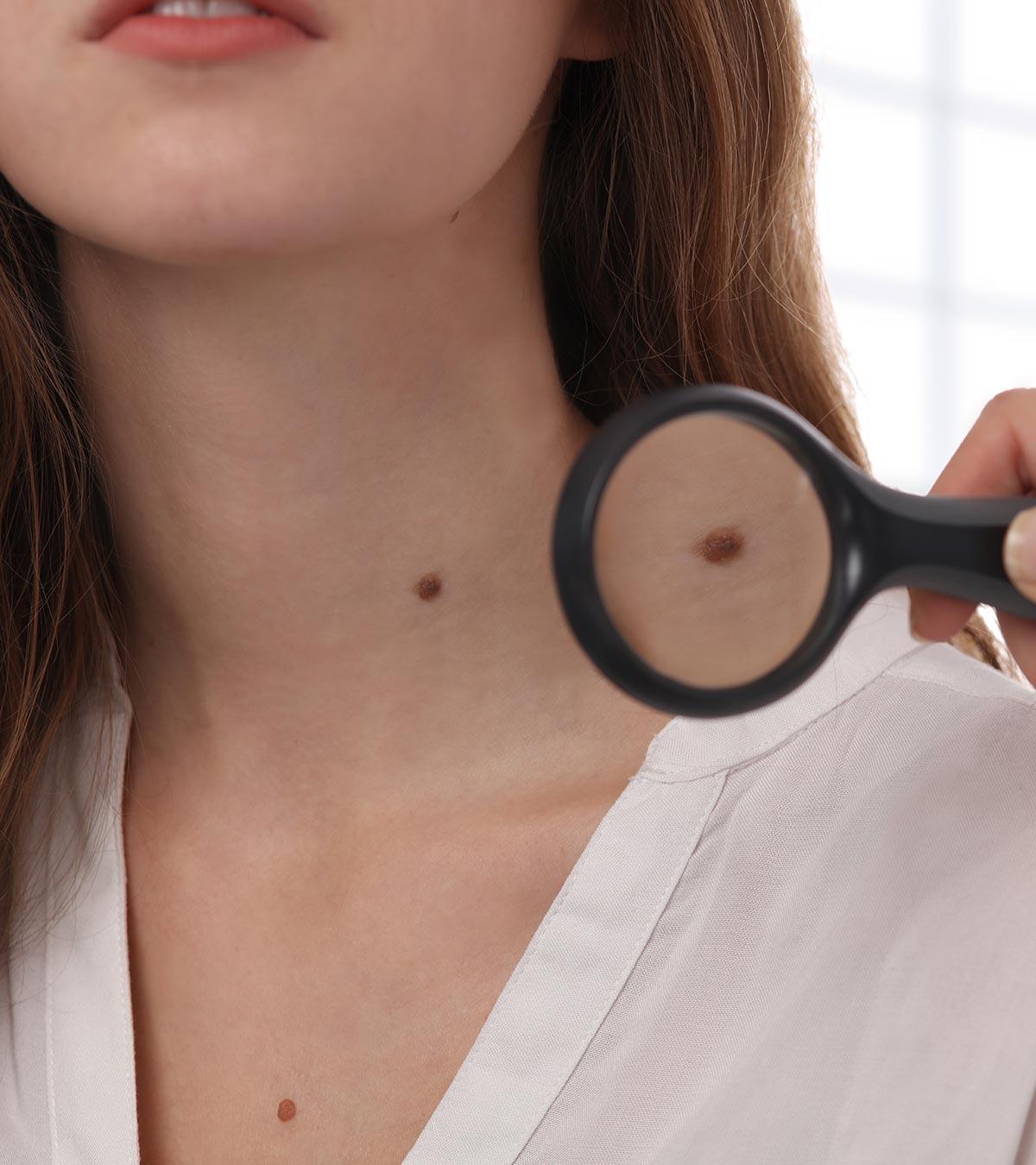 Skin Tags During Pregnancy: Causes, Treatment, And Remedies For Removal