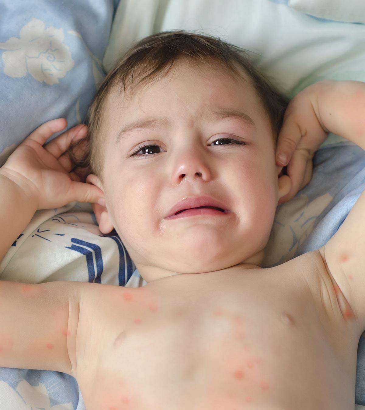 Spider Bites In Toddlers Causes Symptoms Treatments