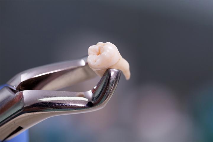 Surgery is the most effective way of removing wisdom teeth while breastfeeding. 