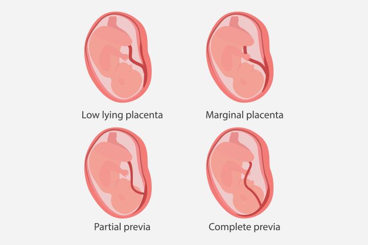 A growth scan can help determine the presence of placenta previa