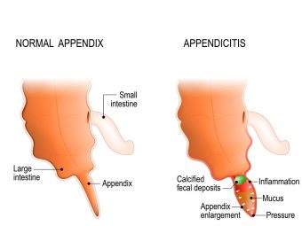 Appendicitis In Teens Symptoms, Causes, Treatment, And Remedies
