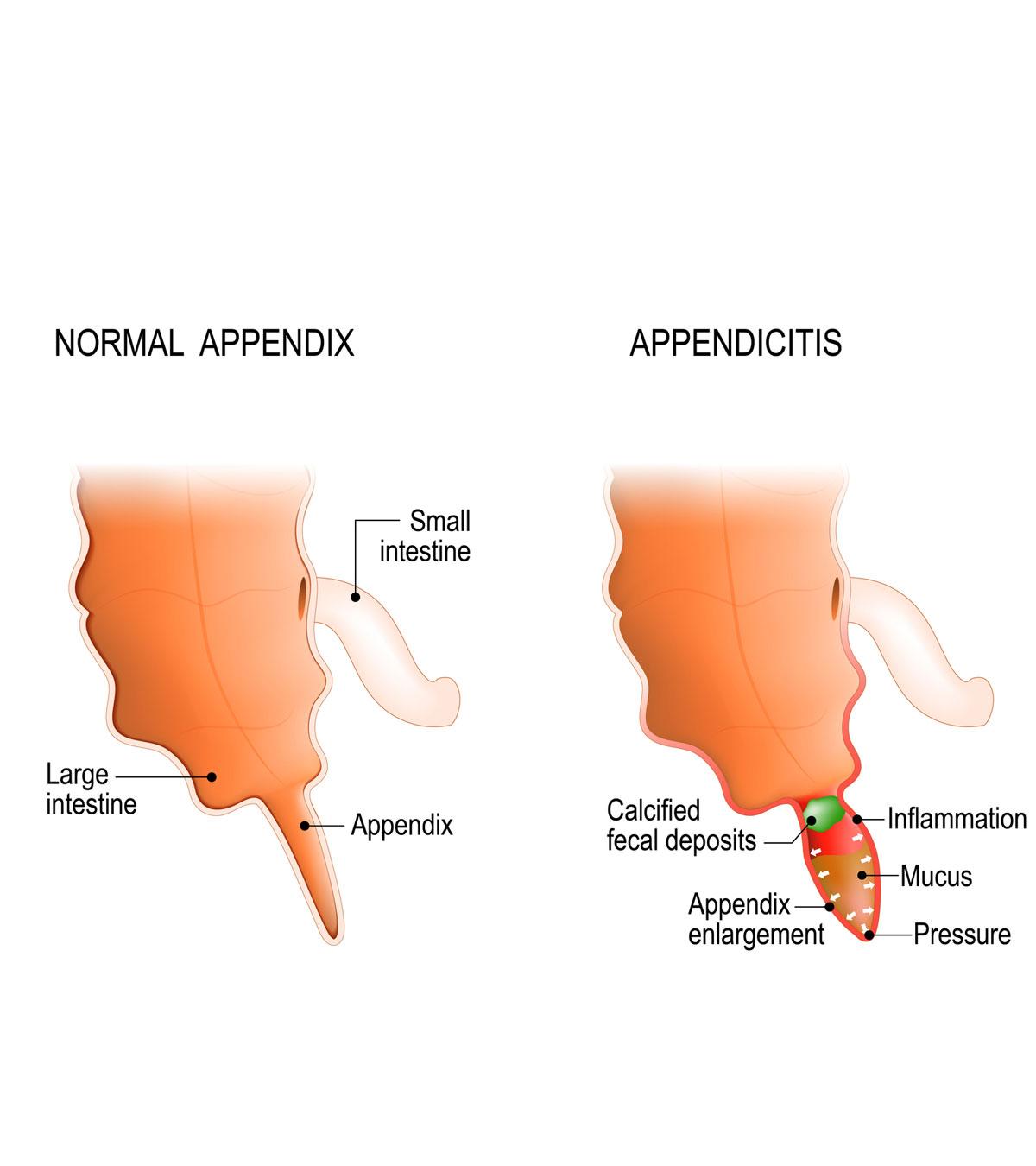 Showing appendicitis diagram