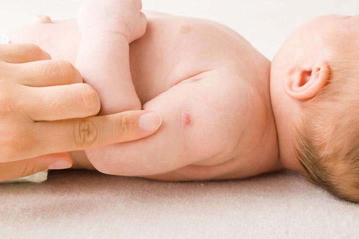 Localized reaction at the vaccination site in babies