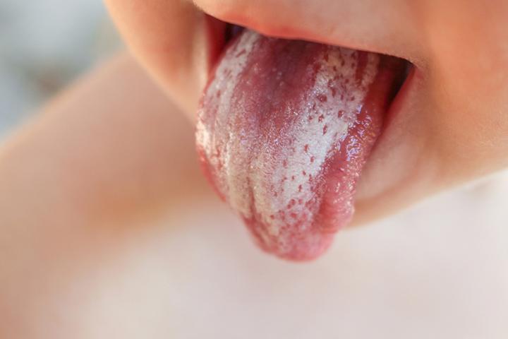 Symptoms of thrush in babies