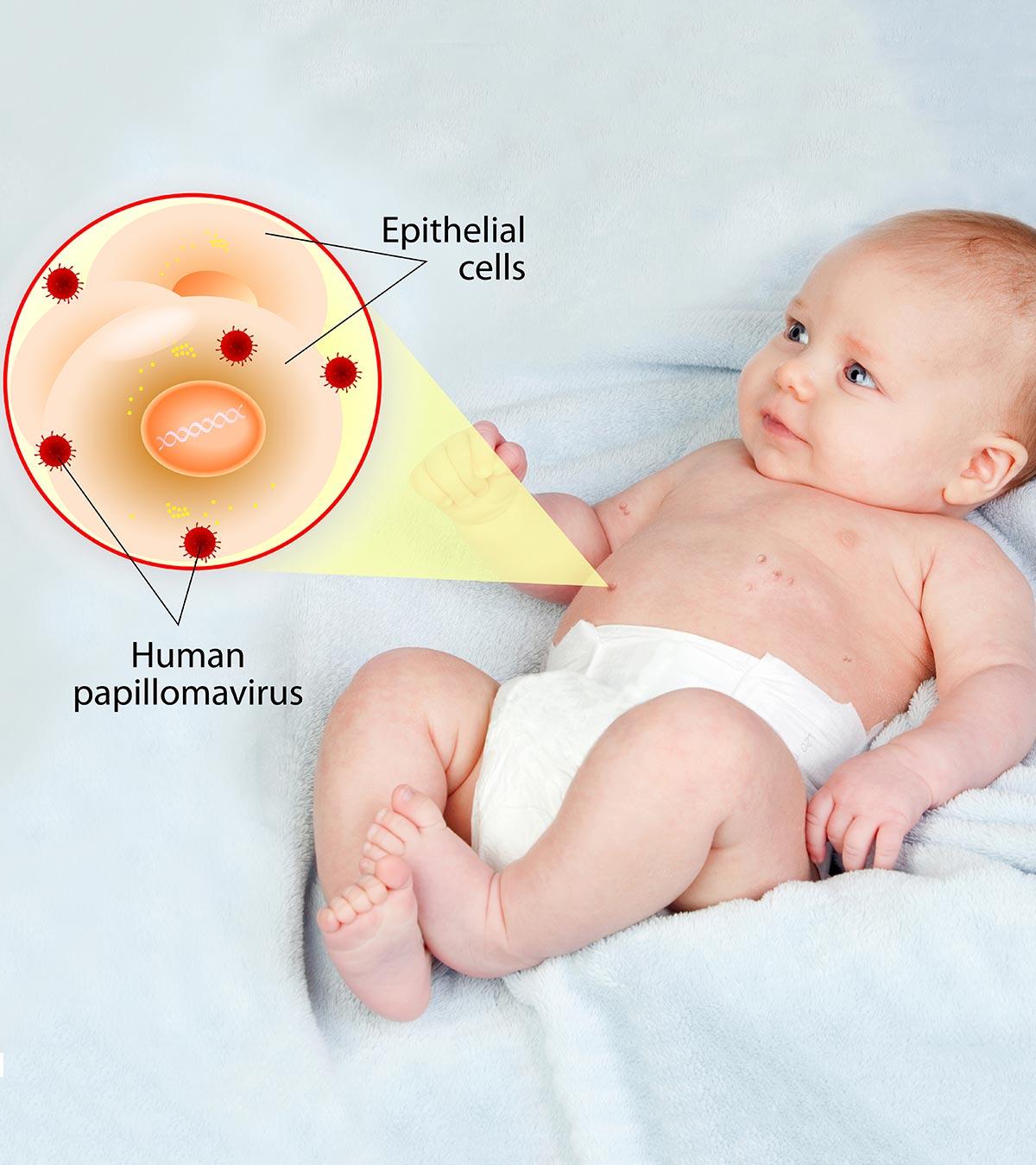 Warts On A Baby