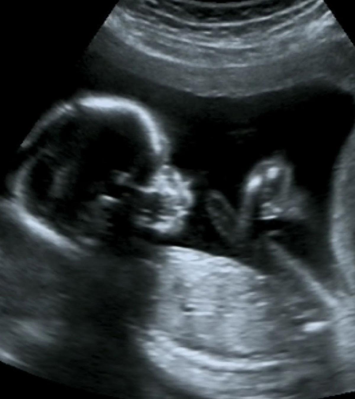 Placental Lake During Pregnancy