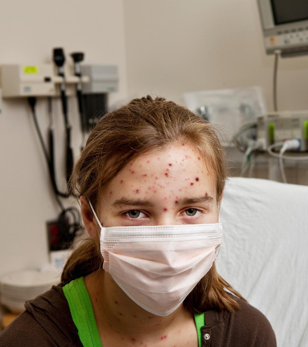 Chickenpox (Varicella) In Children1