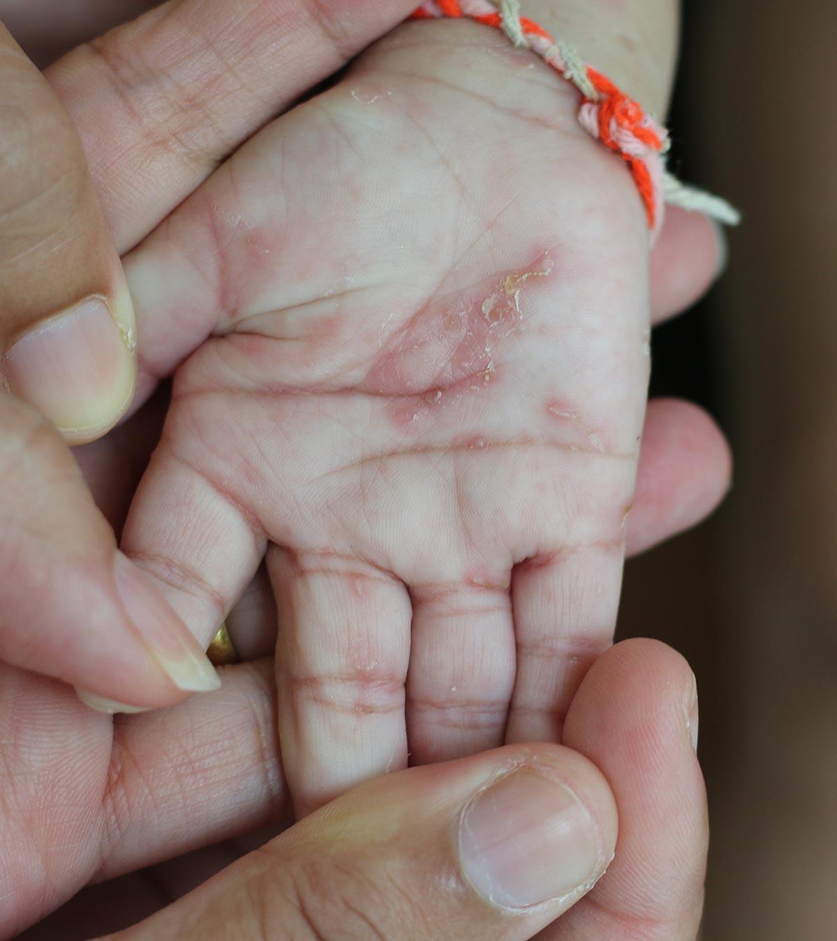 Baby With Scabies Rash