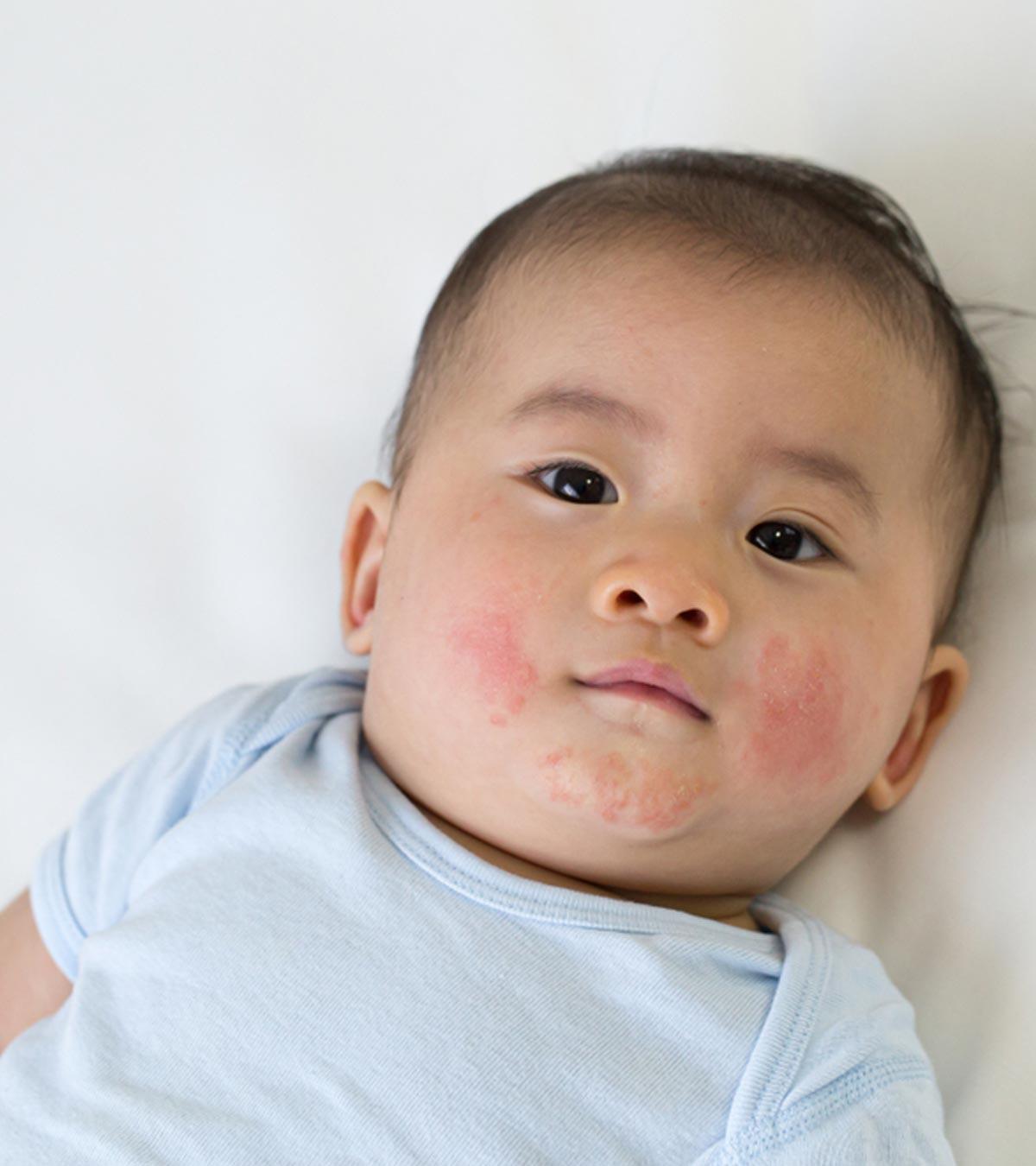 Toddler Suffering From Acne