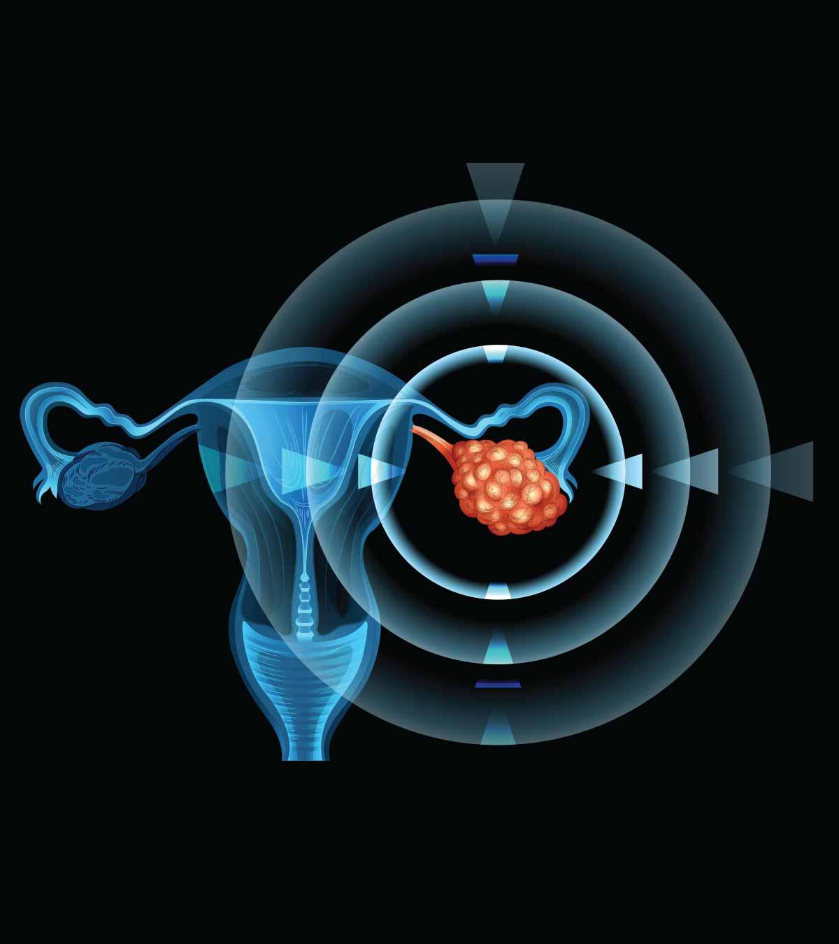 Ovarian Cancer in Teens