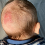 Fungal Infection In Babies Risks, Treatment And Remedies