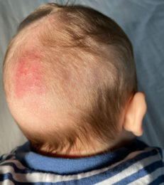 Fungal Infection In Babies: Risks, Treatment And Remedies
