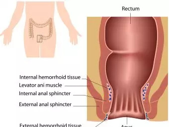 Hemorrhoids-In-Teens-–-CausesSymptoms-And-Treatment