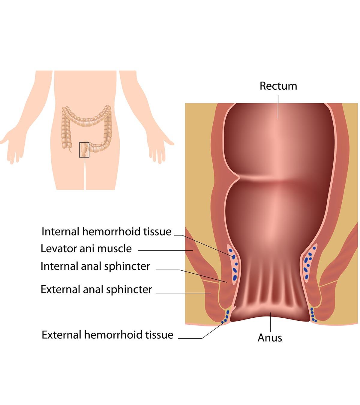 Representation Of Hemorrhoids In Teens