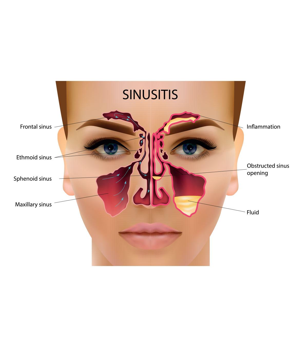 Sinus Infection When Breastfeeding: Treatment And Home Remedies