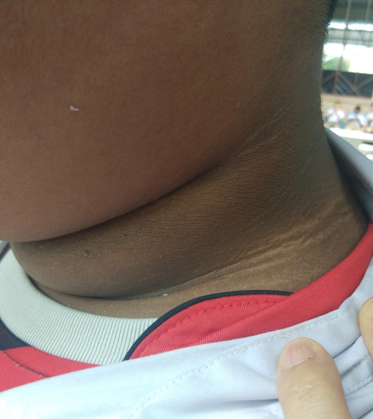 Acanthosis nigricans in kids