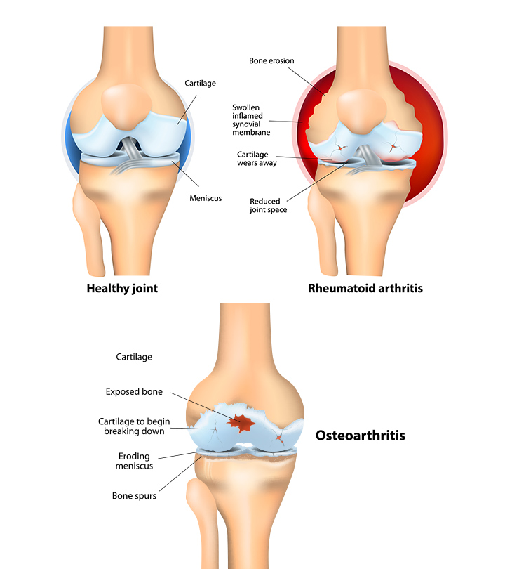 Phentermine and pain in joints