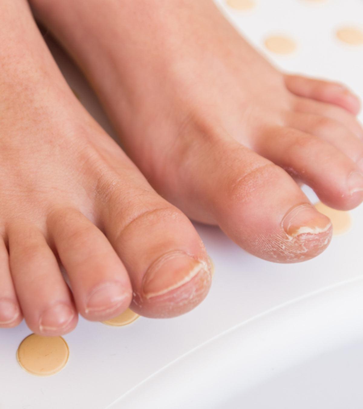 Child’s Infected Nail, Highlighting Fungal Nail Infection